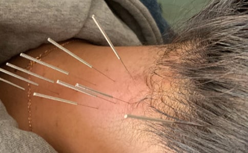 第一次针灸小学作文